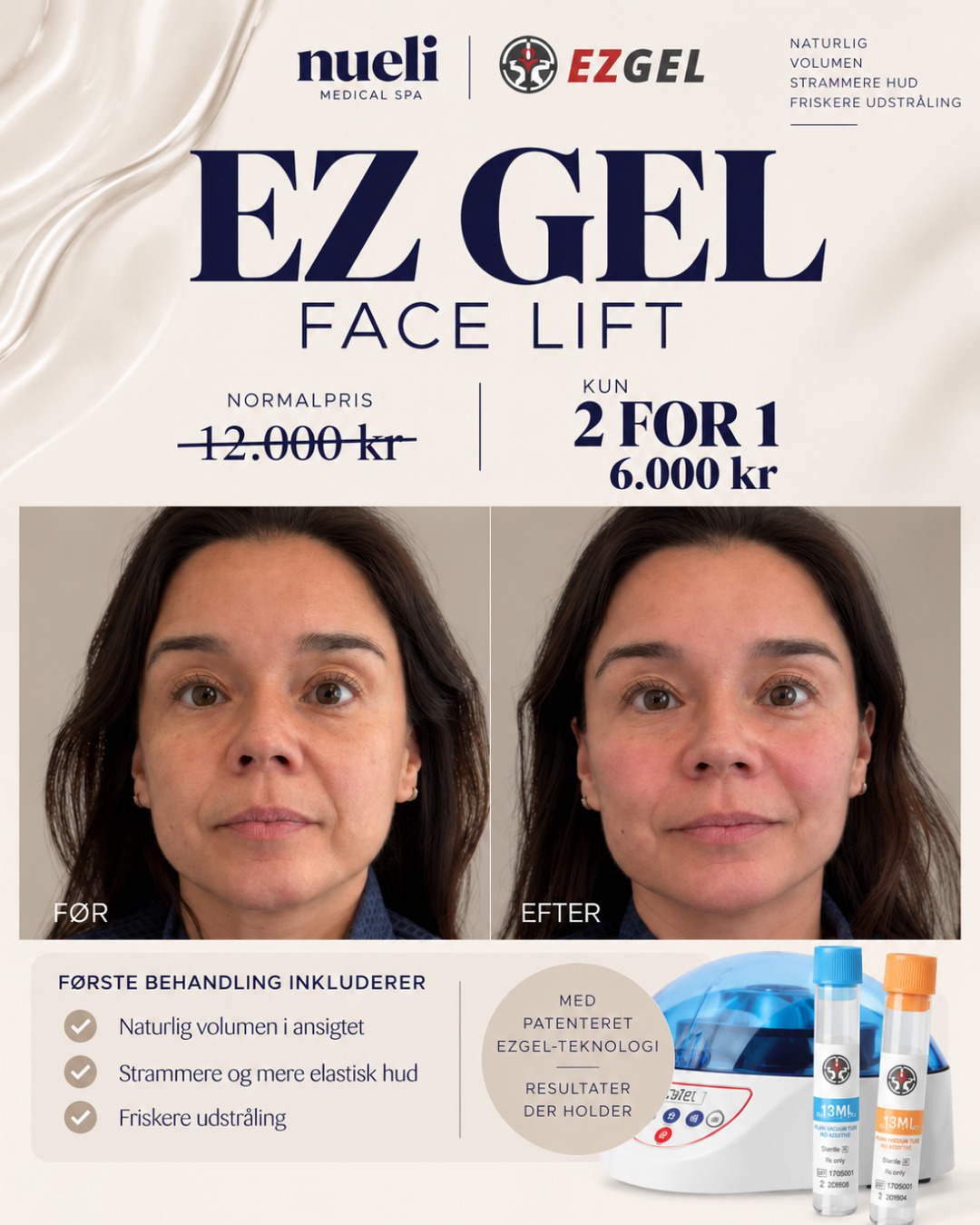 EZ Gel Face Lift 2 for 1. Spar 50 %. Kun 6.000 kr for 2 behandlinger. Før og efter.